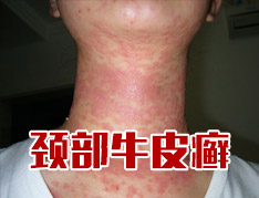 银屑病会给人造成什么伤害